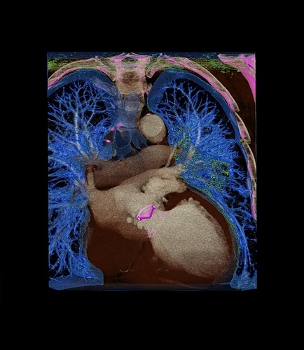 Coronary artery bypass graft CT scan